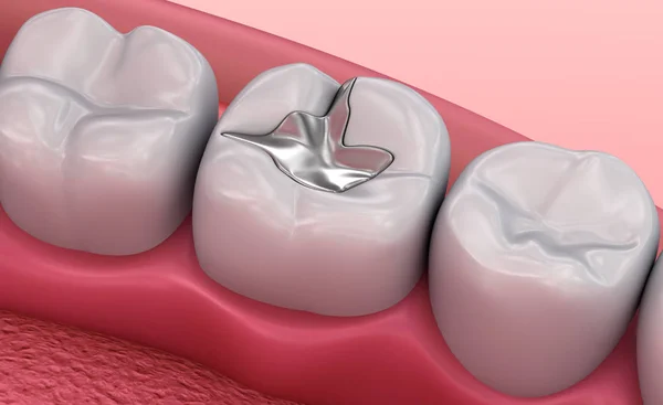 Enchimentos Dentários Metal Ilustração Medicamente Precisa — Fotografia de Stock