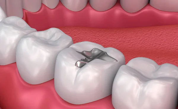 Riempimenti Dentali Metall Illustrazione Clinicamente Accurata — Foto Stock