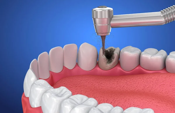 Eliminando Las Caries Ilustración Dientes Médicamente Precisos — Foto de Stock