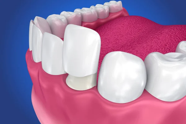Impiallacciature Dentali Impiallacciatura Porcellana Procedura Illustrazione — Foto Stock
