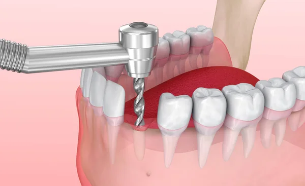 Zubní Implantát Proces Instalace Lékařsky Přesný Obrázek — Stock fotografie