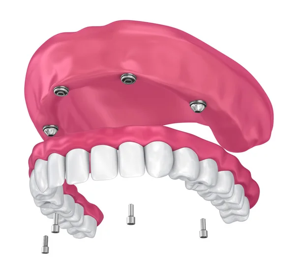 Overdenture Zitten Implantaten Bijlagen Illustratie — Stockfoto