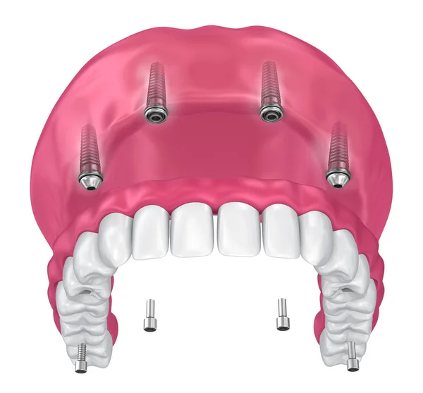 Overdenture Seated Implants Attachments Illustration — Stock Photo, Image