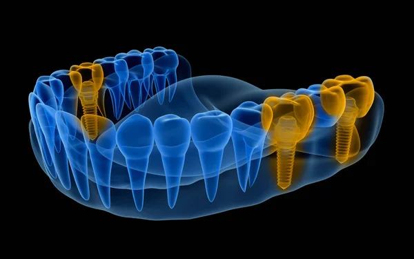 Rentgenové Zobrazení Chrupu Implantáty Pohled Xray Lékařsky Přesné Ilustrace — Stock fotografie