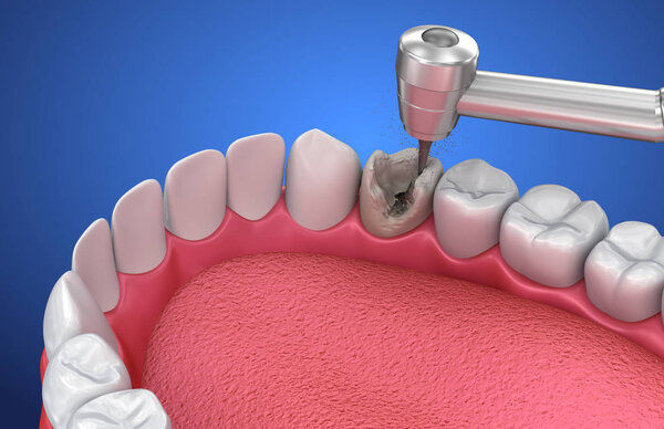 Removing the caries . Medically accurate tooth 3D illustration
