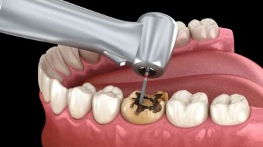 Caries çıkarma işlemi, hazırlık, taç yerleştirme. Tıbbi olarak doğru diş 3D animasyonu.