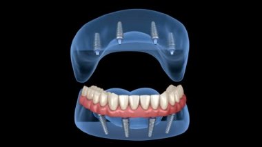 Çikletli Maxillary ve Mandibular protez hepsi de implantlarla desteklenen 4 sistemde. İnsan dişlerinin ve takma dişlerinin tıbbi açıdan doğru 3D animasyonu