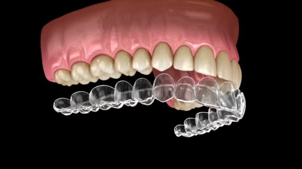 Отбеливание зубов с помощью инвизилайновых брекетов или невидимого фиксатора. 3D анимация — стоковое видео