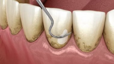 Ağız temizliği: Ölçekleme ve kök planlama (geleneksel periodontal terapi). İnsan diş tedavisinin tıbbi açıdan doğru 3 boyutlu animasyonu
