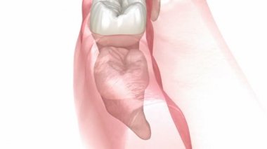 Bilgelik dişinin dikey, yatay ve distal çarpması. Tıbbi olarak doğru diş 3D animasyonu 