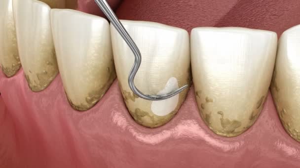 Igiene orale: Scalatura e piallatura delle radici (terapia parodontale convenzionale). Animazione 3D clinicamente accurata del trattamento dei denti umani — Video Stock