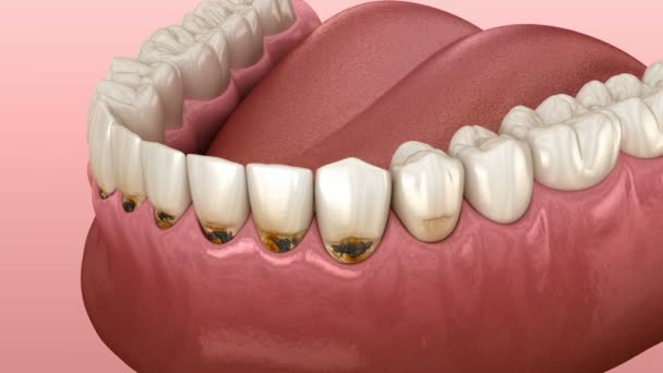Caries cervical en dientes frontales. Animación 3D de dientes médicamente precisa — Vídeo de stock