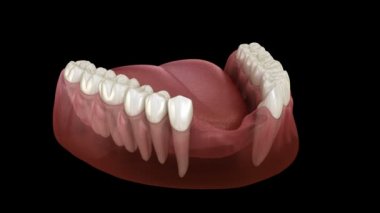 Ön diş köprüsü implantlar tarafından destekleniyor