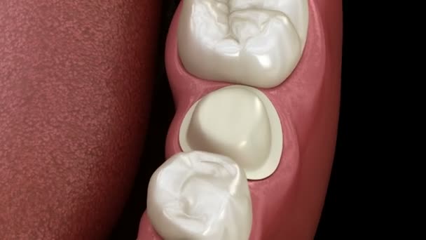 Подготовленная премоляр зуб и зубной металлокерамическая коронка — стоковое видео