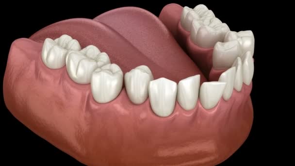 Överträngande tandtäppning (Malocclusion av tänder ) — Stockvideo