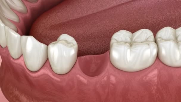 Ponte Maryland feita de cerâmica, recuperação de dentes dianteiros . — Vídeo de Stock