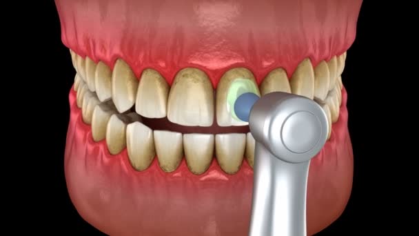 Процедура полірування зубів професійним пензлем та гелем. Медично точна 3D анімація — стокове відео