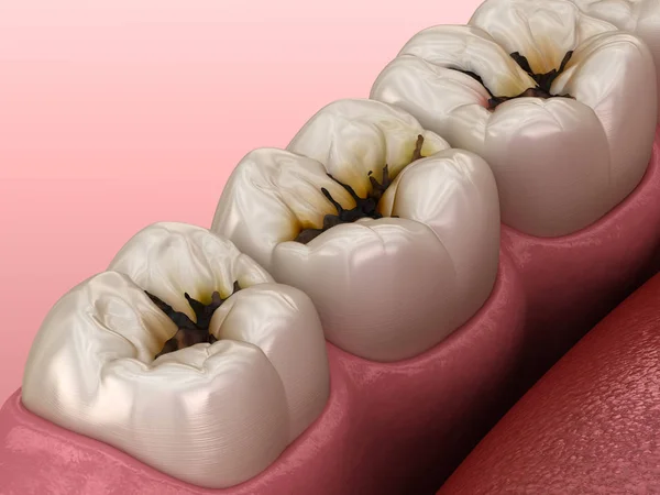 Molaire Tanden Beschadigd Door Cariës Medisch Nauwkeurige Tand Illustratie — Stockfoto