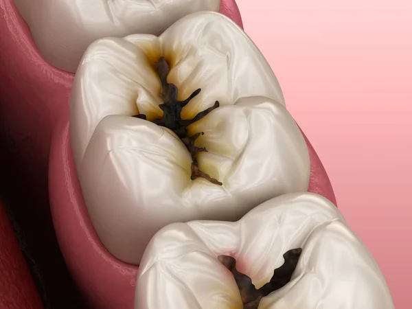 Molar Teeth Damaged Caries Medically Accurate Tooth Illustration — Stock Photo, Image