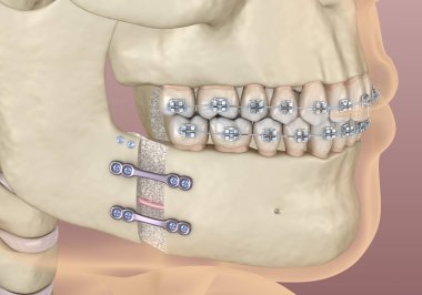 Mandibular Gelişim Cerrahisi. Tıbbi olarak doğru olan 3 boyutlu diş illüstrasyonu.