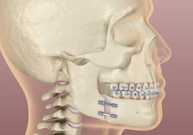 Mandibular Gelişim Cerrahisi. Tıbbi olarak doğru olan 3 boyutlu diş illüstrasyonu.