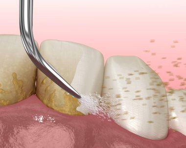 Ağız temizliği: Ölçekleme ve kök planlama (geleneksel periodontal terapi). İnsan diş tedavisinin tıbbi açıdan doğru üç boyutlu çizimi