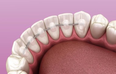 Retainers dental installed after braces treatment, Medically accurate dental 3D illustration clipart