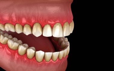 Tatar ve sırt izi diş plağı, çene iltihabı. İnsan diş tedavisinin tıbbi açıdan doğru üç boyutlu çizimi
