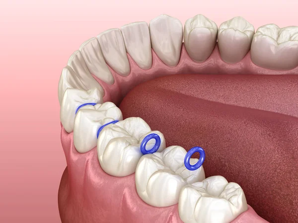 Dişlerin Arasındaki Lastik Ayırıcı Diş Tellerinin Yerleştirilmesi Için Hazırlık Tıbbi — Stok fotoğraf
