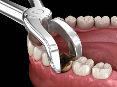Azı dişinin alınması bakteriler tarafından zarar görmüş. Tıbbi olarak doğru diş 3D illüstrasyon.