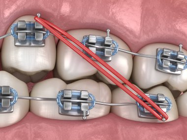 Lastik ve metal teller diş düzeltme için. Tıbbi olarak doğru olan 3 boyutlu diş illüstrasyonu