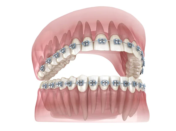 Bretelle Metalliche Modello Dentale Trasparente Illustrazione Clinicamente Accurata — Foto Stock