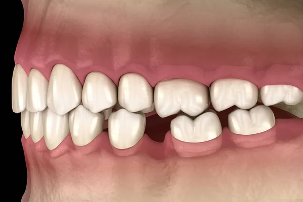 Deformace Zubů Ztrátě Stoličkového Zubu Ilustrace Fenoménu Popov Godon — Stock fotografie