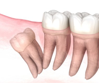 Bilgelik dişinin uzak etkisi. Tıbbi olarak doğru diş 3D illüstrasyon