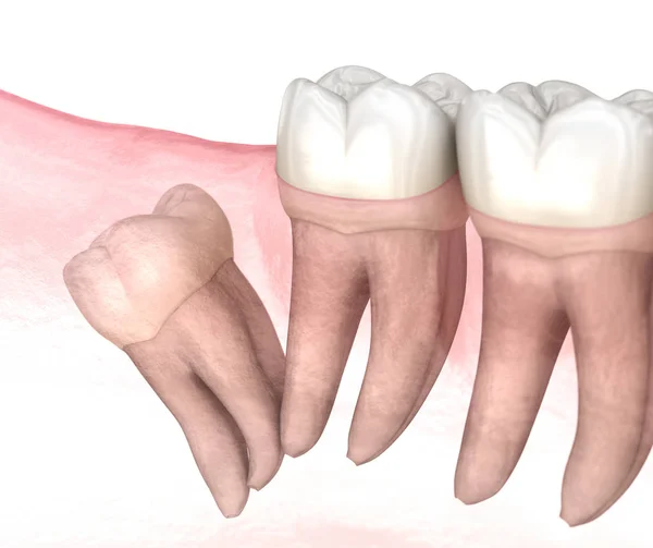 Distal impaction of Wisdom tooth. Medically accurate tooth 3D illustration