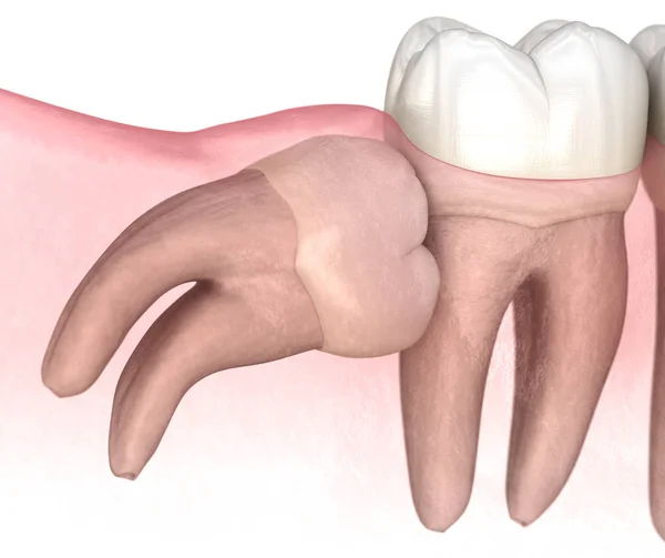 智齿的水平撞击 医学上准确的牙齿3D图像 — 图库照片