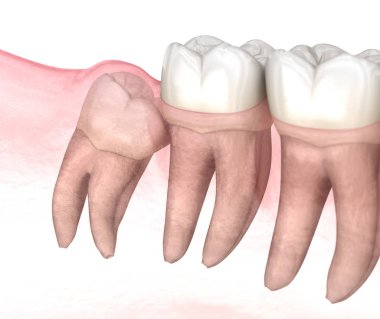 Mesial impaction of Wisdom tooth. Medically accurate tooth 3D illustration clipart