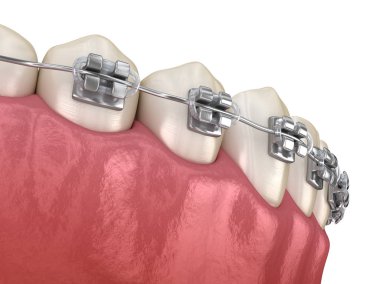 Metal telli sağlıklı dişler, Macro manzaralı. Tıbbi olarak doğru olan 3 boyutlu diş illüstrasyonu