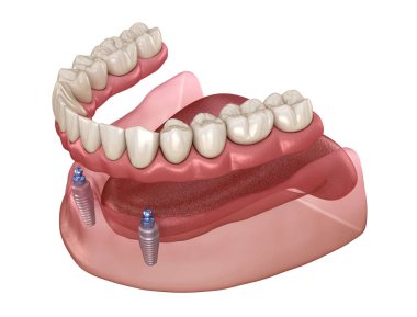 Alt çene çıkarılabilir protez. Hepsi top eklentili implantlar tarafından desteklenen 2 sistemde. Tıbbi olarak doğru olan 3 boyutlu diş illüstrasyonu