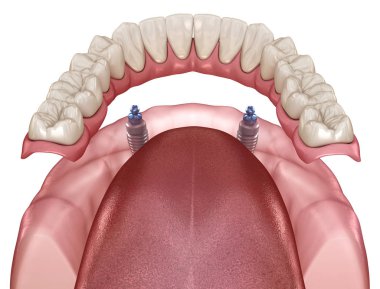 Alt çene çıkarılabilir protez. Hepsi top eklentili implantlar tarafından desteklenen 2 sistemde. Tıbbi olarak doğru olan 3 boyutlu diş illüstrasyonu