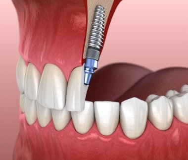 İmplant ile merkezi Kesici Tedavi İyileşmesi. Diş kavramının tıbbi olarak doğru 3d illüstrasyon