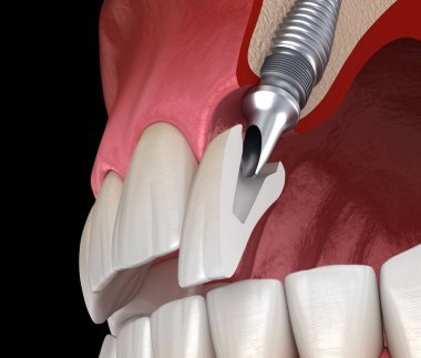 İmplant ile merkezi Kesici Tedavi İyileşmesi. Diş kavramının tıbbi olarak doğru 3d illüstrasyon