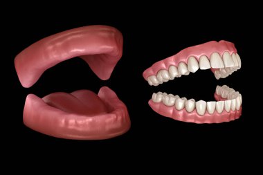 Maxillary and Mandibular prosthesis, artificial dentures. Medically accurate 3D illustration of human teeth and dentures clipart