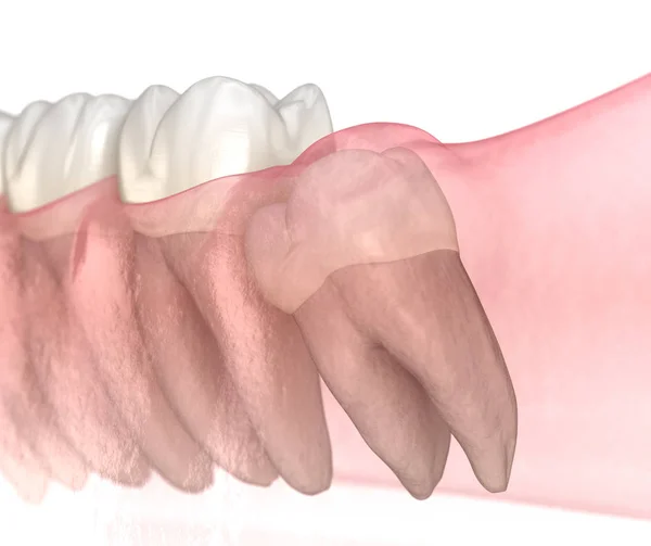 Mesial Impactie Van Wijsheid Tand Medisch Nauwkeurige Tand Illustratie — Stockfoto