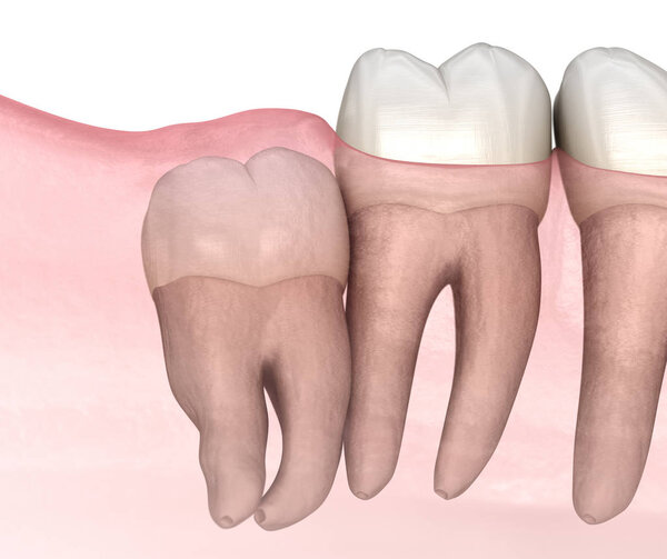 Vertical impaction of Wisdom tooth. Medically accurate tooth 3D illustration