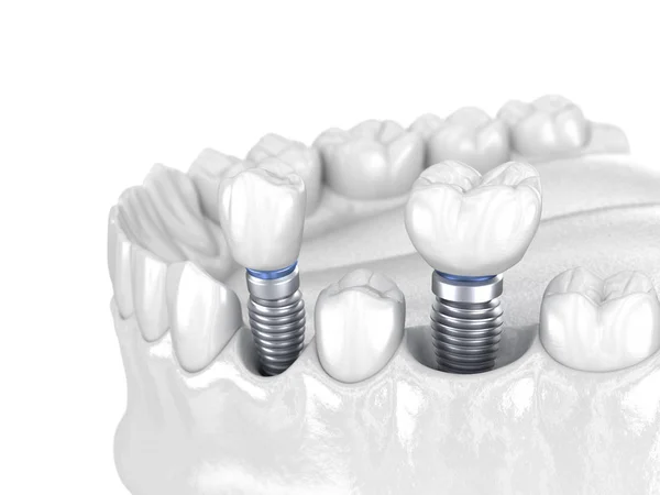 Premolar Och Molar Tand Krona Installation Över Implantat Vitt Koncept — Stockfoto