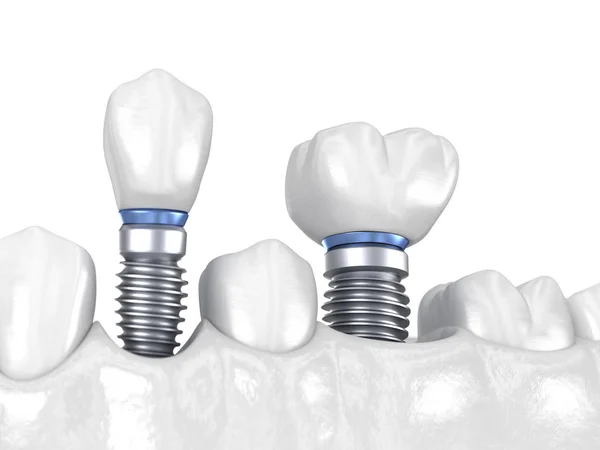 Premolar Και Molar Δόντι Κορώνα Εγκατάσταση Πάνω Εμφύτευμα Λευκό Έννοια — Φωτογραφία Αρχείου