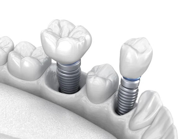 Instalación Corona Dentaria Premolar Molar Sobre Implante Concepto Blanco Ilustración — Foto de Stock