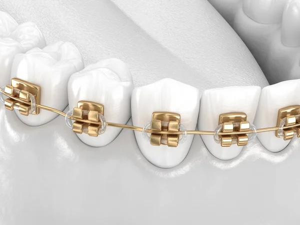 Dentes Saudáveis Com Aparelho Ouro Conceito Dentes Brancos Ilustração Dental — Fotografia de Stock