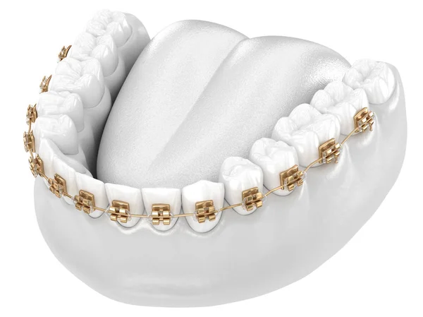 Friska Tänder Med Guld Hängslen Vita Tänder Koncept Dentala Illustration — Stockfoto